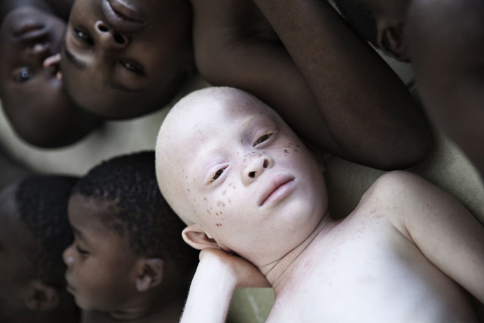 Быть альбиносом в Танзании означает быть злом во плоти. Фото: Marinka Masseus.