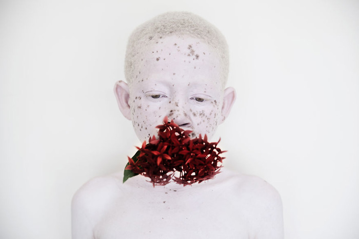 Из-за отсутствия пигментов в коже и глазах, у альбиносов повышен риск заболевания раком.  Фото: Marinka Masseus.