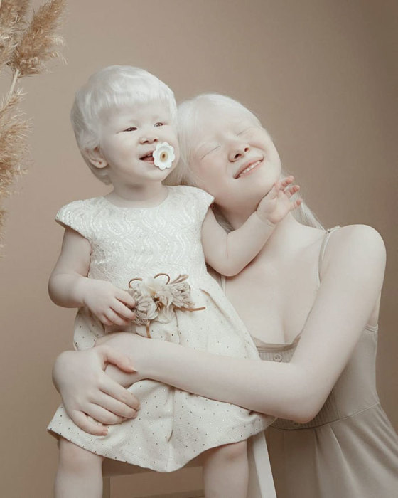 К сожалению, у альбинизма есть и негативные стороны.
