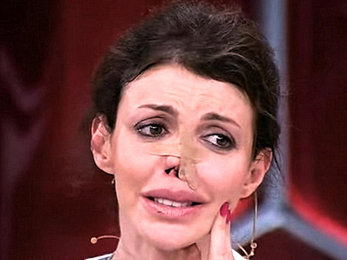 Алиса Казьмина почти лишилась носа после неудачной пластики. / Фото: eg.ru