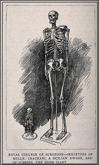 Скелеты мужчины-гиганта и женщины-карлика выставлены в Королевском колледже хирургов.