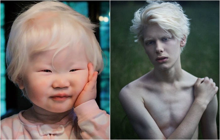 От чего рождаются дети с белыми волосами и бровями