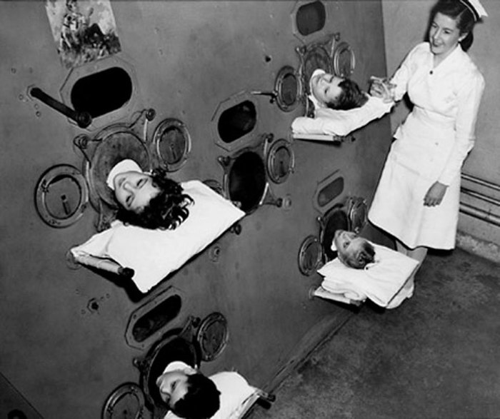 До изобретения вакцины от полиомиелита пациентов помещали в аппарат «железные легкие», который симулировал дыхание, используемый в 1950-е годы.
