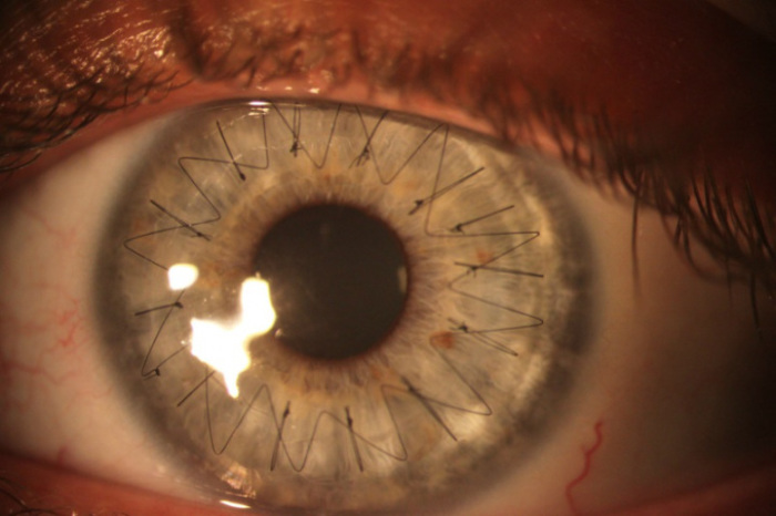 Операция по трансплантации роговицы глаза.