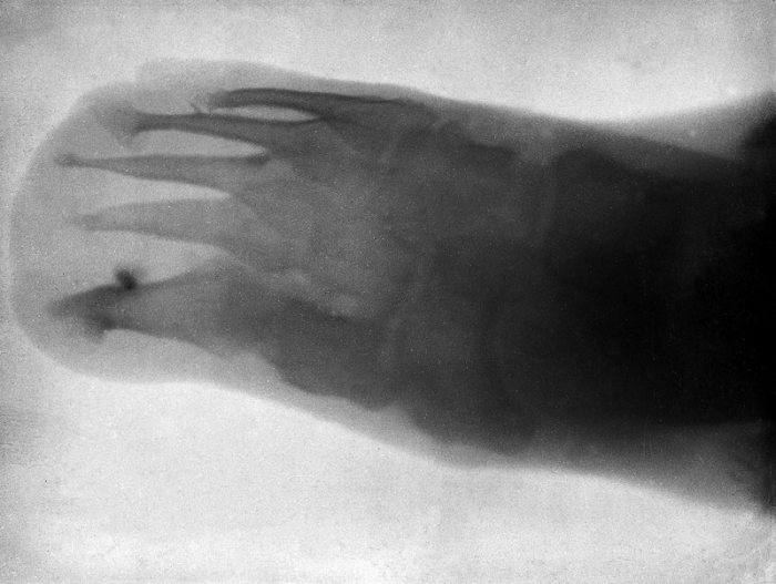 Нога шестилетнего Леонарда Шустера в 1896 году. | Фото: wellcomeimages.org.