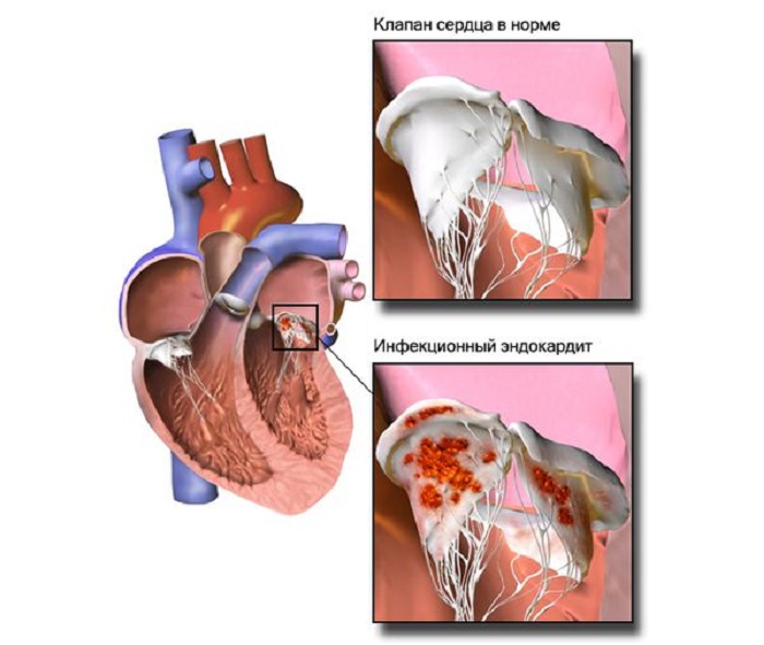 Так выглядит сердце при септическом эндокардите. /Фото: Wikipedia
