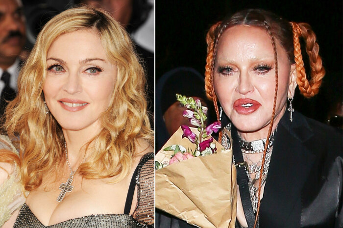 Мадонна до и после пластики. / Фото: wwww.leupold-pro.ru