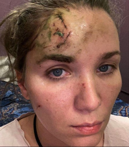 Анастасия Веденская получила увечья в баре. 