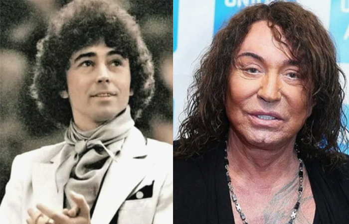 Валерий Леонтьев делал несколько неудачных процедур. 