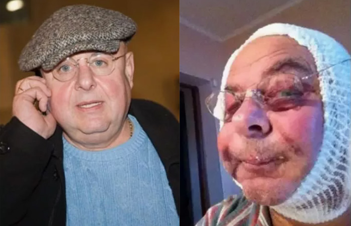 Владимир Долинский тоже прибегал к пластической хирургии.