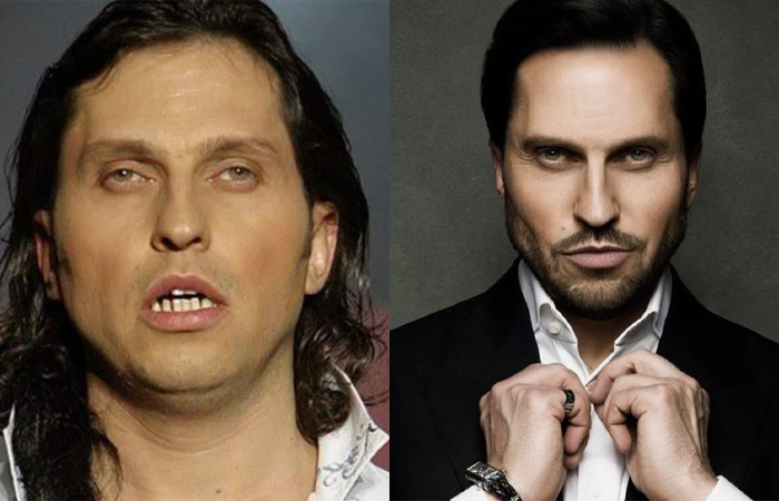 Александр Ревва тоже прибегал к пластике.